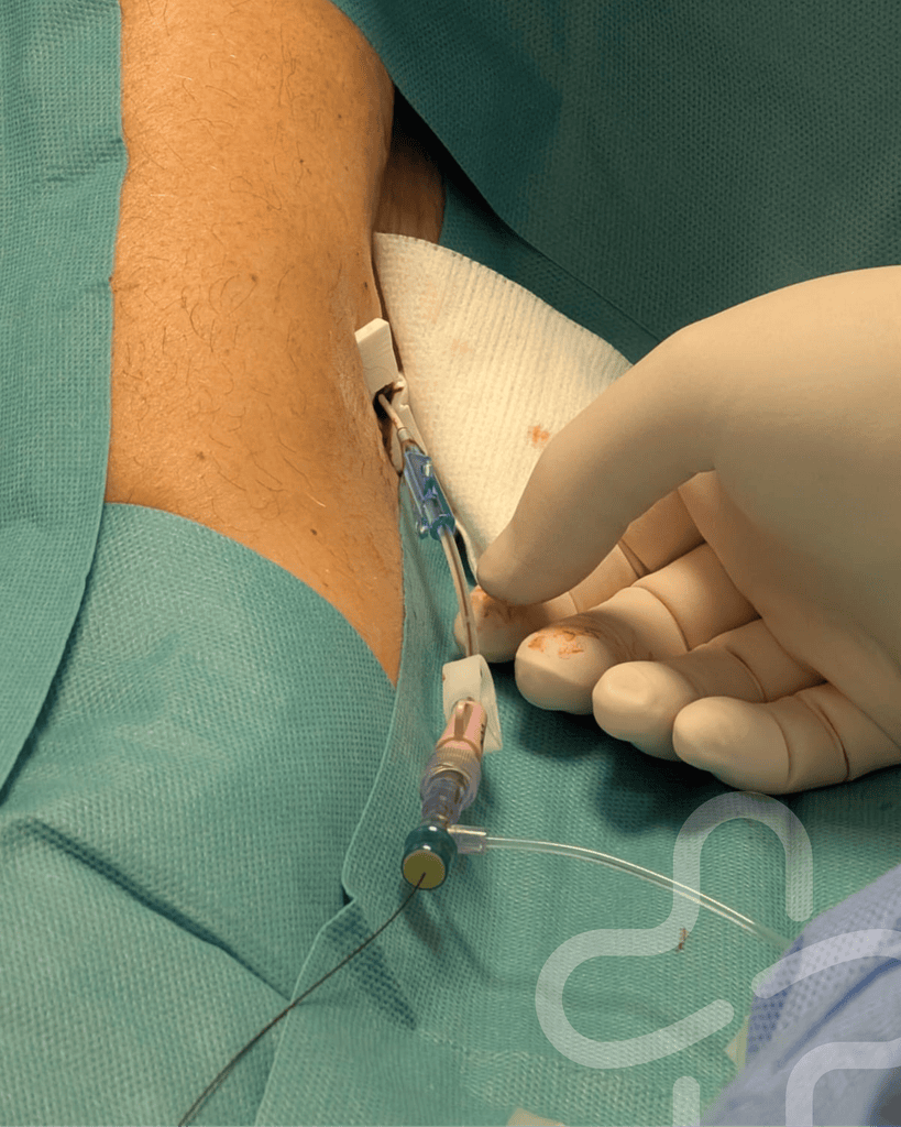 pcc line3 1 - Grande nouvelle à l'Hôpital Marie-Lannelongue : une première pour l'Unité d'Accès Vasculaire (UAV) !